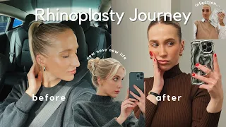 Miami Rhinoplasty Journey✨ what nobody tells about a nose job✅ before and after rhinoplasty🌼