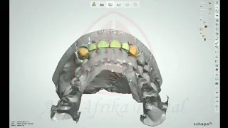 The Strength and Beauty of Zirconia in Anatomical Coping