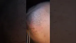 ingrown hair pull out speedx2 with tweezers!  Satisfying 222 #shorts #satisfying  #well  #removal