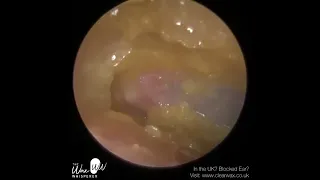 1,092   Fully Blocked Ear Wax & Dead Skin Removal​ 006