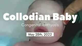 Congenital Ichthyosiform Erythroderma (Collodian Baby)