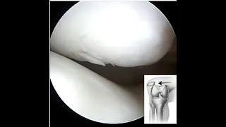 What does a Patella (Knee Cap) Dislocation look like?