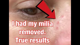 I had my milia removed | Full experience and true results