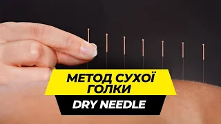 Метод сухої голки/Dry Needle/ Відповіді на найпоширеніші запитання