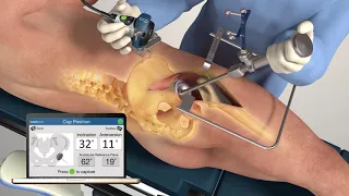 Intellijoint HIP Lateral and Posterior by Intellijoint Surgical 3D Animation