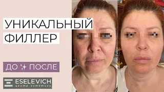 RADIESSE Омоложение. Что происходит на самом деле? РЕЗУЛЬТАТЫ ДО И ПОСЛЕ!