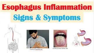 Esophagitis (Esophagus Inflammation) Signs & Symptoms (& Why They Occur)