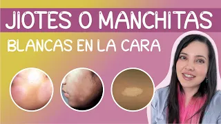 ¿JIOTES? MANCHAS BLANCAS en la cara , te cuento sobre la PITIRIASIS ALBA