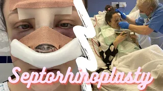 SEPTORHINOPLASTY VLOG UK MY EXPERIENCE & RECOVERY