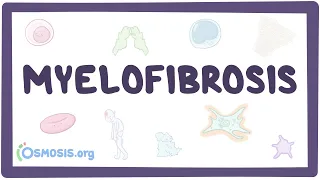 Myelofibrosis - causes, symptoms, diagnosis, treatment, pathology