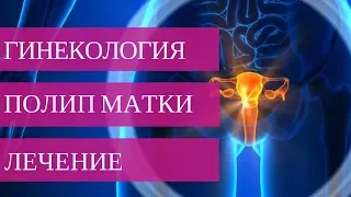 Полип полости матки  - лечение. Что такое Гистероскопия? | Добрый Прогноз