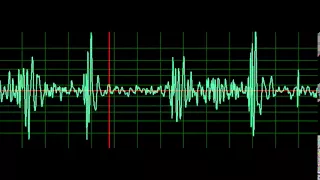 Prosthetic Valve Aortic Valve Mitral Regurgitation- normal speed