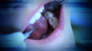 Can Getting a Root Canals Have Dangerous Side Effects?