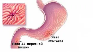 Язвенная болезнь желудка и двенадцатиперстной кишки