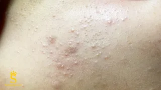 Blind Pimple Under the Skin | Mụn Ẩn Dưới Da- SacDepSpa#179