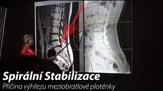 Jaké jsou příčiny vzniku výhřezu meziobratlové ploténky?