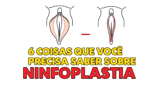 NINFOPLASTIA - CIRURGIA ÍNTIMA 6 DICAS IMPORTANTES