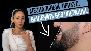 Мезиальный прикус. Как исправить без операции?