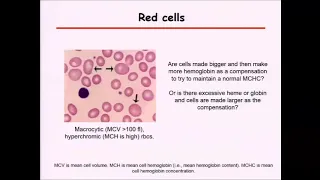 Myelodysplastic syndrome (MDS) and anemia