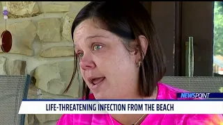 Indiana girl contracts flesh-eating disease from Florida beach