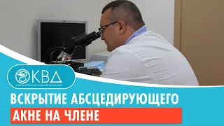 😐 Вскрытие абсцедирующего акне на члене. Клинический случай №188