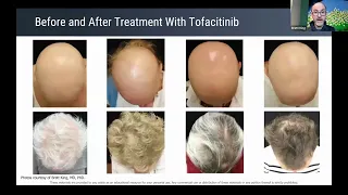 Alopecia areata treatment update and lessons learned from recent clinical trials