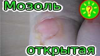 Чем лечить открытую мозоль