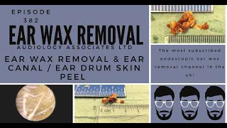 EAR WAX REMOVAL & EAR CANAL/EARDRUM SKIN PEEL - EP382