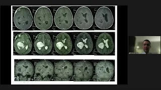 Surgical approach to pediatric thalamic tumors