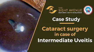 Cataract Surgery in case of Intermediate Uveitis | Eye Surgery Case Study Video | Live Procedure