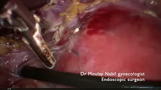 Complex hysterectomy on frozen pelvis