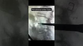 Percutaneous Lumbar Fusion