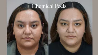 What you need to know about Chemical Peels