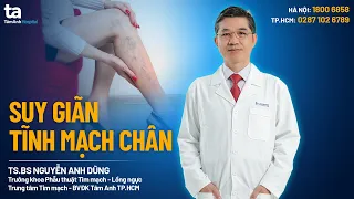 Suy giãn tĩnh mạch chân (chi dưới) là gì? Nguyên nhân, dấu hiệu và cách điều trị | Tâm Anh