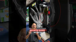 Boxer’s Fracture Complications⁉️ #shorts