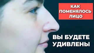 СКОЛЬКО СТОИТ ПЛАСТИКА НОСА / МОЯ РИНОПЛАСТИКА