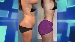 How the Body Reacts to a Brazilian Butt Lift