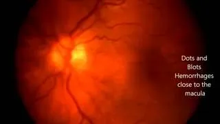 Moderate non proliferative diabetic retinopathy