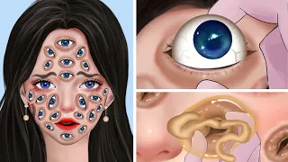 ASMR Remove parasitic eyes & Large pustules on face | Acne Deep Cleaning Animation