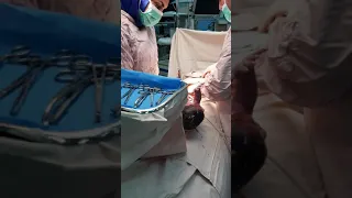 18 June 2020   cesarean section in shomal hospital