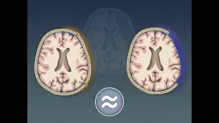 Craniectomy vs. Craniotomy for Acute Subdural Hematoma | NEJM