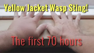 YELLOW JACKET WASP STING: The first 70 hours