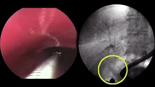 Severe portal venous bleed during ERCP treated with EUS-guided hepaticogastrostomy