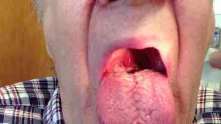 Palate and Uvula Tremor