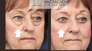 Dr McCracken's paitent gives a testimonial after her surgical rejuvenation