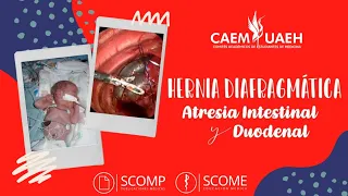 Patología quirúrgica neotanal (I) ''Hernia diafragmática, atresia intestinal y  duodenal ''