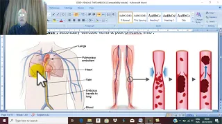 Venous Disorders in English  3 ( Deep venous thrombosis , pathology&complications ) , by Dr.Wahdan