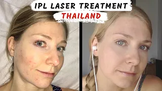 Acne in Thailand | Cheap IPL REVIEW  (What happened + how to clear skin)