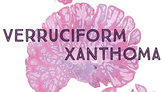 Verruciform xanthoma - clinical mimic of condyloma (AIP France 2021 - Case 7)