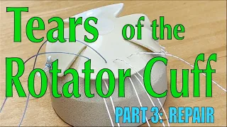 Tears of the Rotator Cuff Part 3: Suture Anchor Repair of the Rotator Cuff